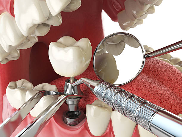 Best Emergency Dentist for Knocked-Out Tooth in Sultan, WA